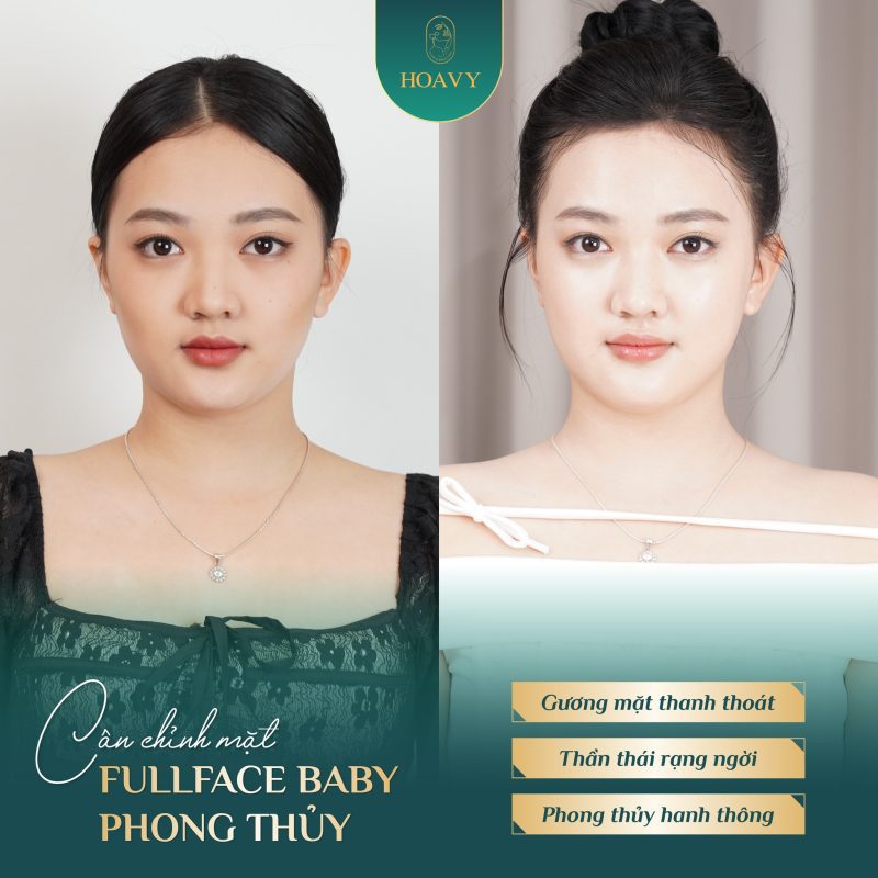 Cân chỉnh mặt Hải Phòng Fullface Baby phong thủy – Gương mặt hài hòa, hợp tướng số 7 Cân chỉnh mặt Hải Phòng tại Thẩm mỹ viện Hoa Vy diễn ra an toàn, hiệu quả thấy rõ ngay sau liệu trình