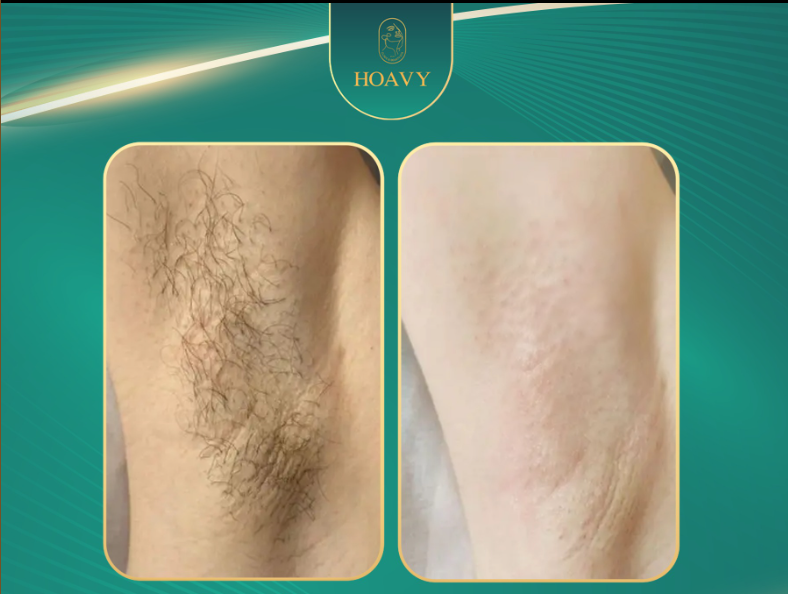 Hieu qua su dung dich vu triet long tai TMV Hoa Vy 2