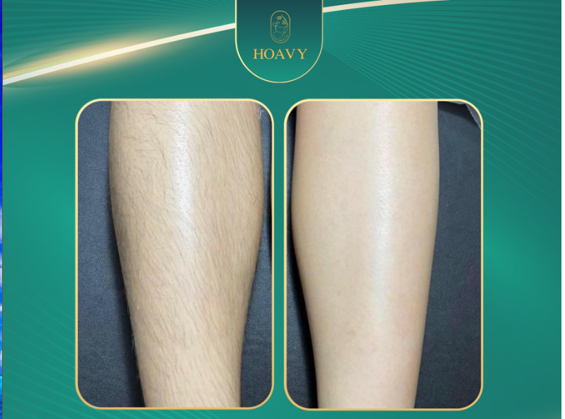 Hieu qua su dung dich vu triet long tai TMV Hoa Vy 3