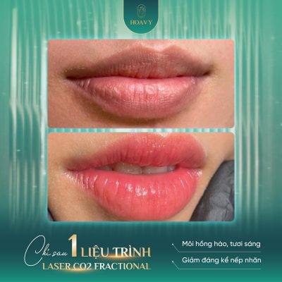 Khử thâm môi Hải Phòng