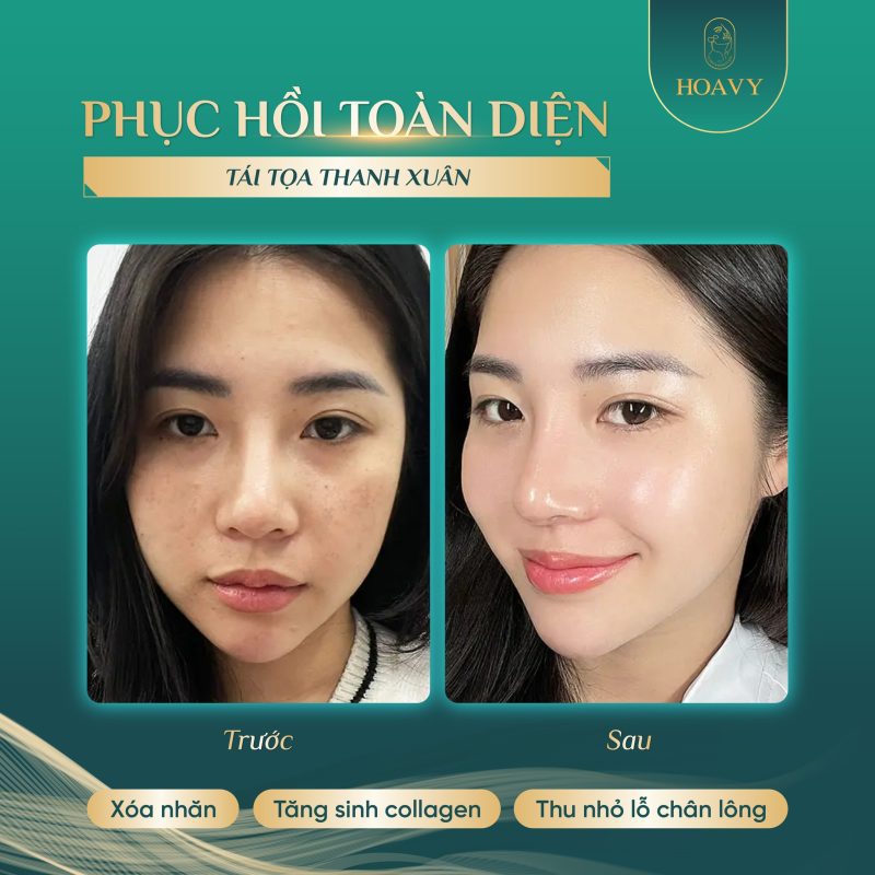 Khách hàng trước và sau khi sử dụng dịch vụ Meso căng bóng thủy lực âm