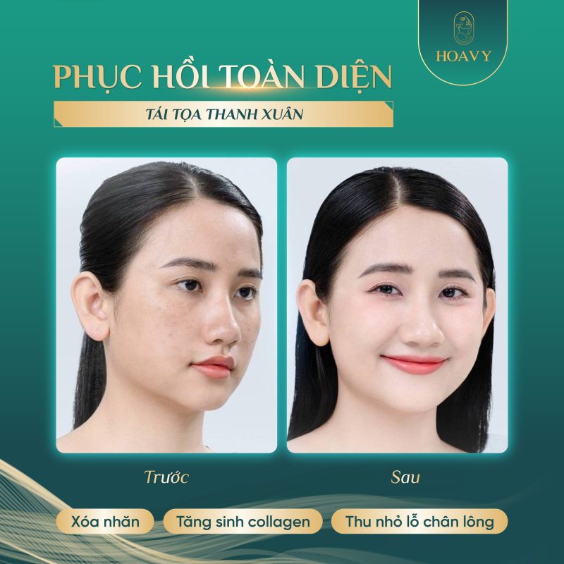 Khách hàng trước và sau khi sử dụng dịch vụ Meso căng bóng thủy lực âm