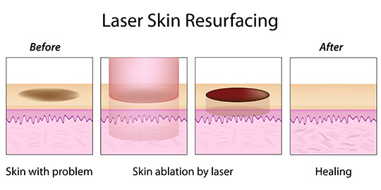 Da được tái tạo bằng Laser CO2 Fractional.