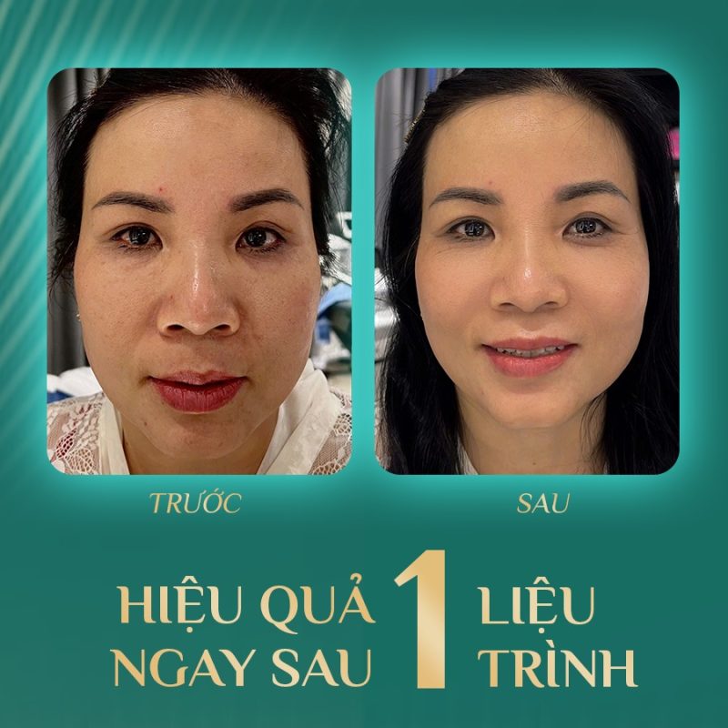 Hiệu quả phục hồi da khô Hải Phòng thấy rõ sau một liệu trình