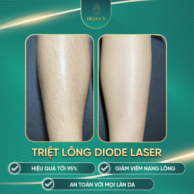 Hình ảnh trước-sau của khách hàng sau liệu trìnhtriệt lông tuổi dậy thì tại Hải Phòng tại HoaVy