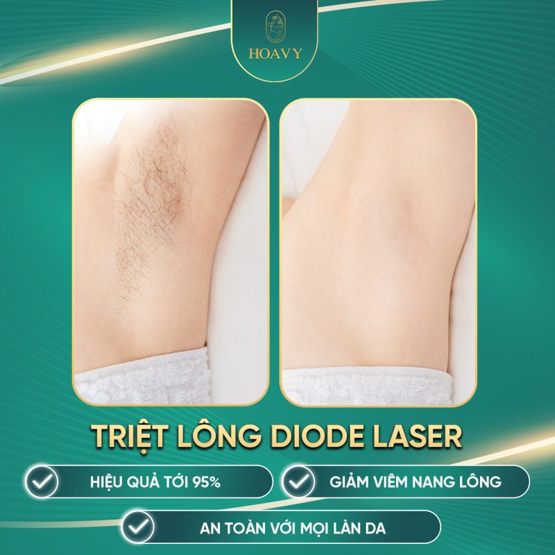 Hình ảnh trước-sau của khách hàng sau liệu trình triệt lông tại HoaVy