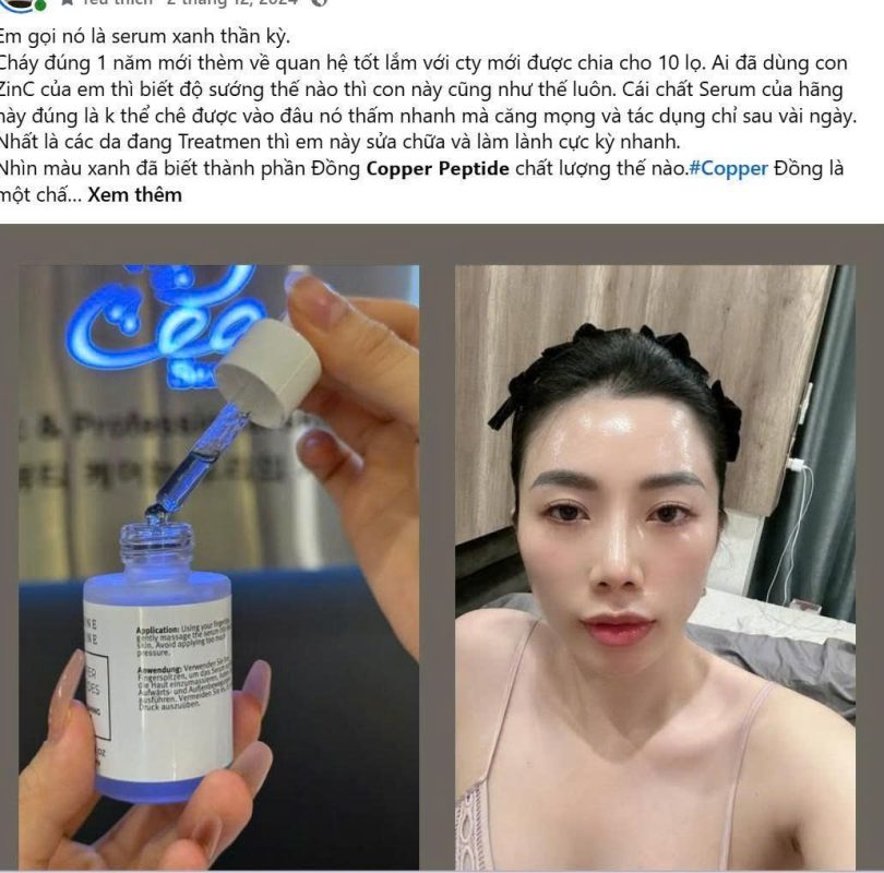 Hình ảnh khách hàng trước – sau khi sử dụng liệu trình phục hồi da sẹo mụn với Copper Peptides tại Thẩm mỹ viện Hoa Vy.