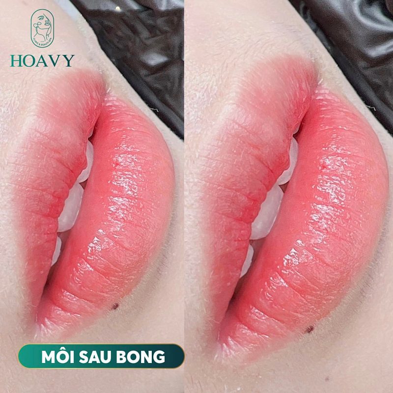 Hình ảnh khách hàng sau khi cấy môi Magic Lips tại HoaVy – đôi môi hồng tươi tự nhiên, căng bóng chỉ sau 1 liệu trình.