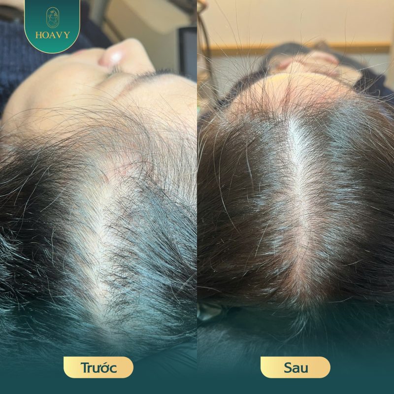 TMV Hoa Vy cam kết phủ hoàn hảo các vùng hói đỉnh đầu, hói trán, tóc thưa
