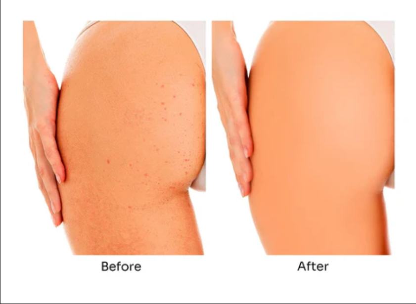 Kem trị mụn mông Elaine Perine – Giải pháp cho làn da mịn màng, tự tin diện mọi trang phục 2 Kem trị mụn mông – một giải pháp tự nhiên, an toàn và hiệu quả giúp xử lý mụn mông, vết thâm mụn và lông mọc ngược trên vùng mông và đùi.